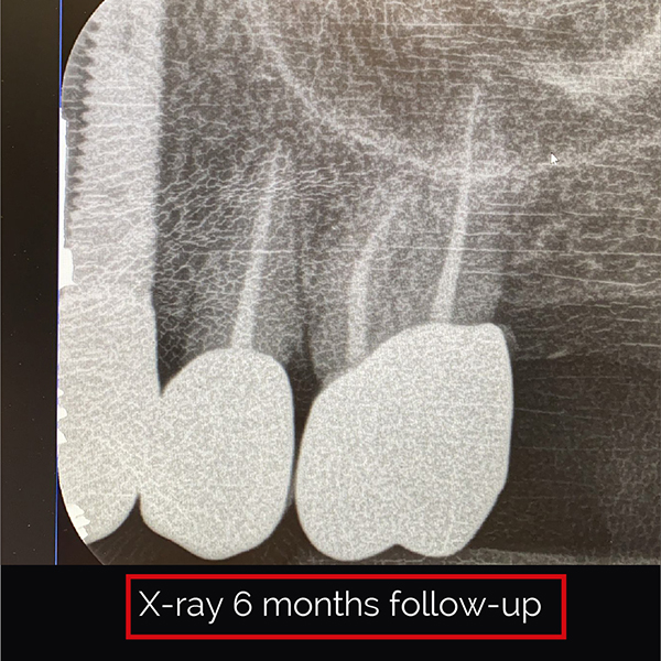Fully digital treated esthetic single crowns on matrix® Tissue-Level ...