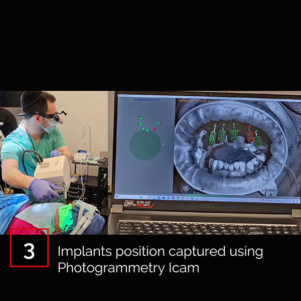 Icam Code Matrix Full Arch Restoration with ICAM ScanBodies and matrix