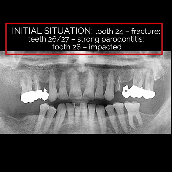 Augmentation 36 3 Unit Zirconia Bridge Directly Screw-retained On 2 Strongly Angulated ...