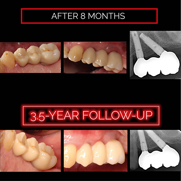 Augmentation 36 3 Unit Zirconia Bridge Directly Screw-retained On 2 Strongly Angulated ...